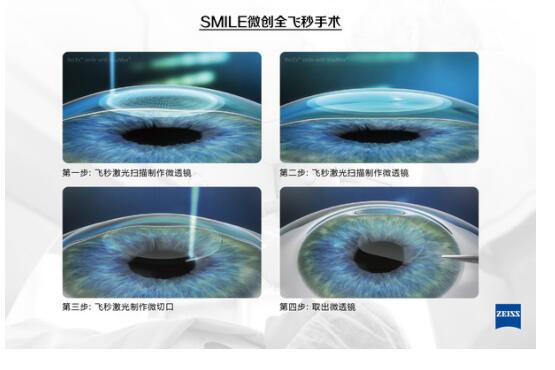有近視，全飛秒激光手術(shù)后視力更好