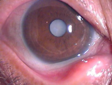 別讓人笑話你沒白內(nèi)障眼病常識(shí)