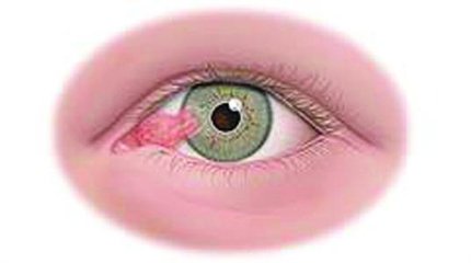 眼睛上會有一塊肉，影響視力怎么辦？