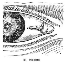 黑眼睛前面多長出一塊白肉怎么辦？