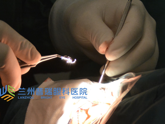 蘭州眼科醫(yī)院 白內障手術后注意事項