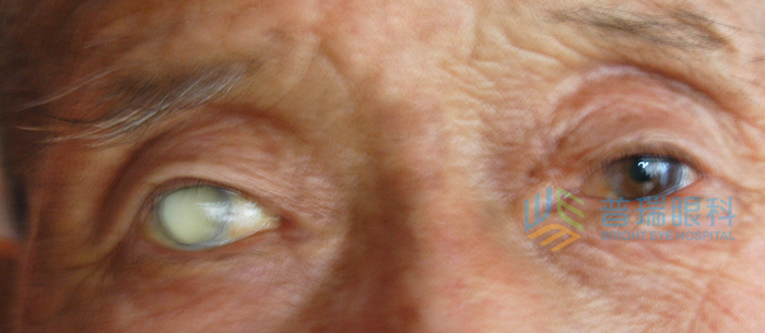 在家中就可以了解白內(nèi)障常識(shí)