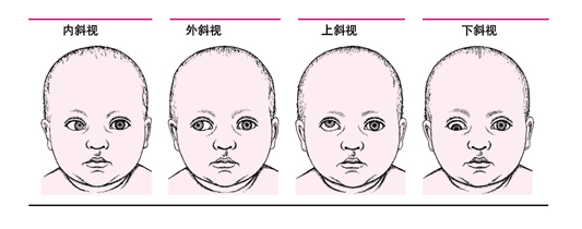 什么是斜視？斜視能嗎？