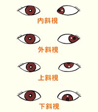 看看兒童斜視眼病怎么預(yù)防？