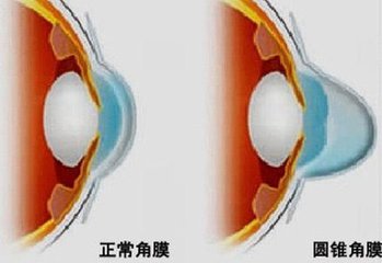 圓錐角膜，哪種角膜移植術(shù)好？