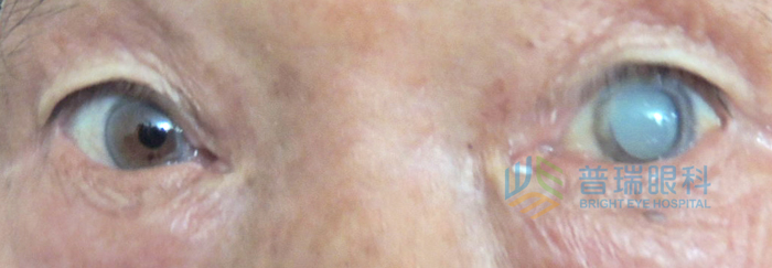 醫(yī)學(xué)小知識(shí)：有哪些因素可造成白內(nèi)障眼病