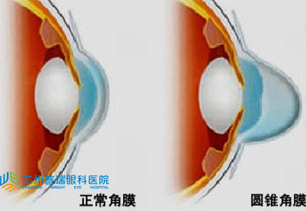 圓錐角膜怎樣？