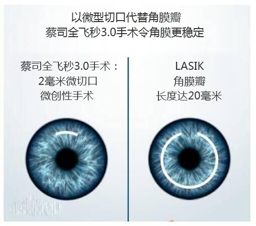 近視手術(shù)有哪幾種？你適合那種快看看