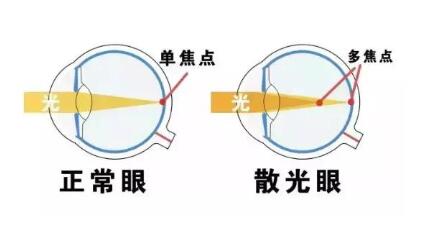 近視和散光，手術(shù)能同時(shí)矯正嗎？