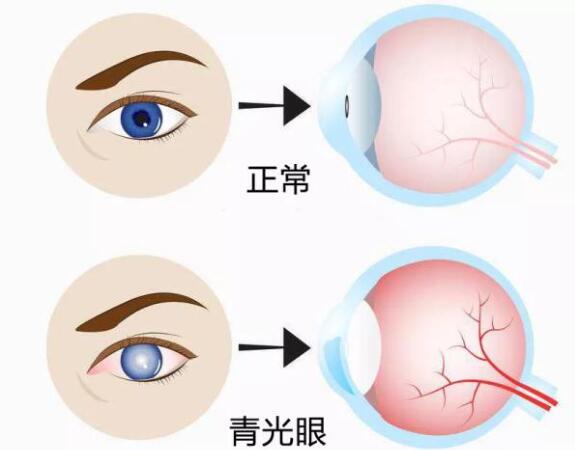 第17個青光眼周｜共管慢病青光眼，留得光明恒久遠